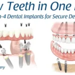 Single Tooth Implant Cost Without Insurance