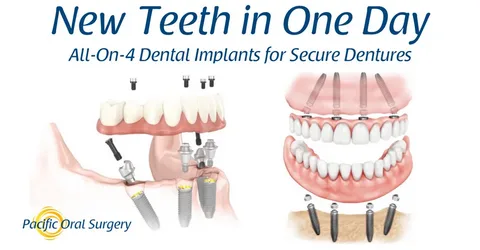 Single Tooth Implant Cost Without Insurance